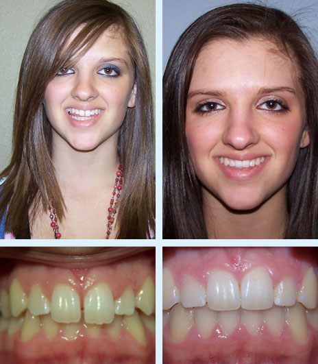 Before and After - Ellis Orthodontics | Roscoe IL Janesville WI