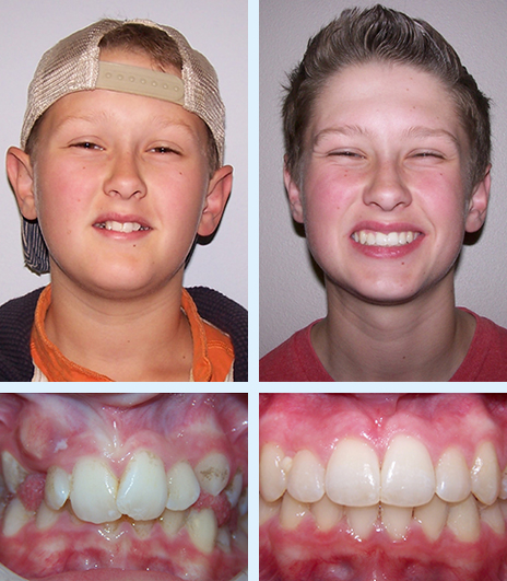 Before and After - Ellis Orthodontics | Roscoe IL Janesville WI